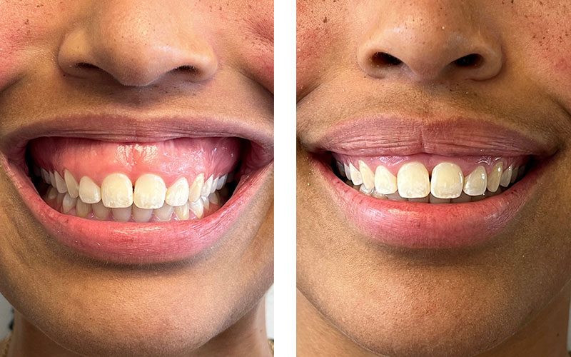 The image shows two close-up photographs of a person s smiling face with teeth, side by side, highlighting an improvement in dental health, likely after orthodontic treatment.