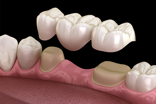 The image shows a 3D rendering of a human tooth with a visible cavity and gumline, set against a dark background.