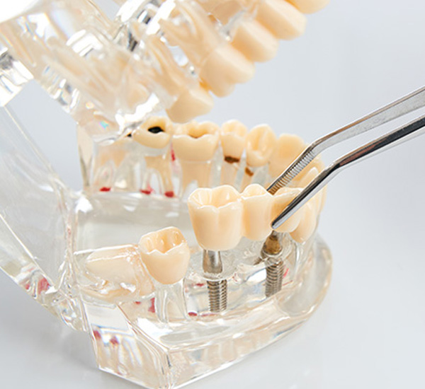 Alt text Clear plastic dental model with teeth and gums, accompanied by dental tools including tweezers and a dental pick.