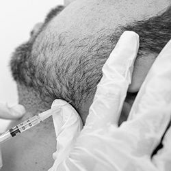 A person receiving a hair transplant with a syringe being used by a medical professional.