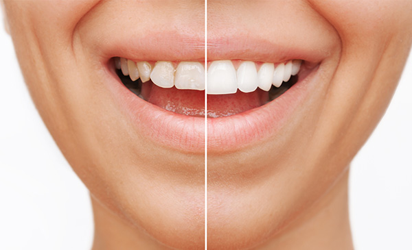 The image shows a close-up of a person s smiling face with teeth, likely used for dental care or cosmetic purposes.