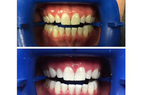 The image shows a dental impression tray with two rows of teeth, one on top of the other, each row containing artificial teeth.