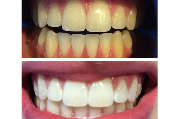 The image displays two photographs side by side showing a person s teeth before and after dental treatment, highlighting the results of cosmetic dentistry with a focus on teeth whitening.