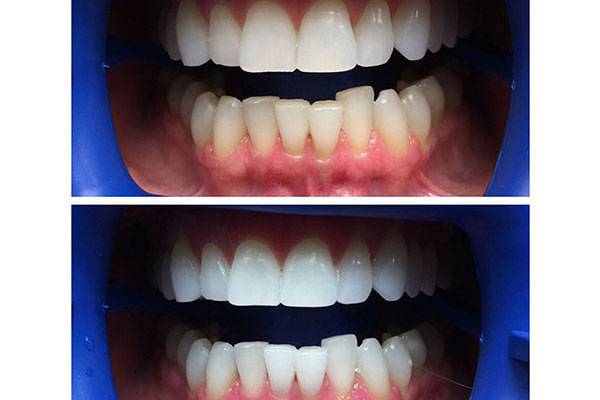 The image displays two photos of a person s teeth with visible signs of dental work, including braces and possibly orthodontic adjustments, against a blue background.