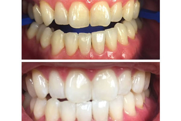 The image displays two photographs side by side of a person s teeth before and after dental treatment, emphasizing the transformation achieved through cosmetic dentistry.