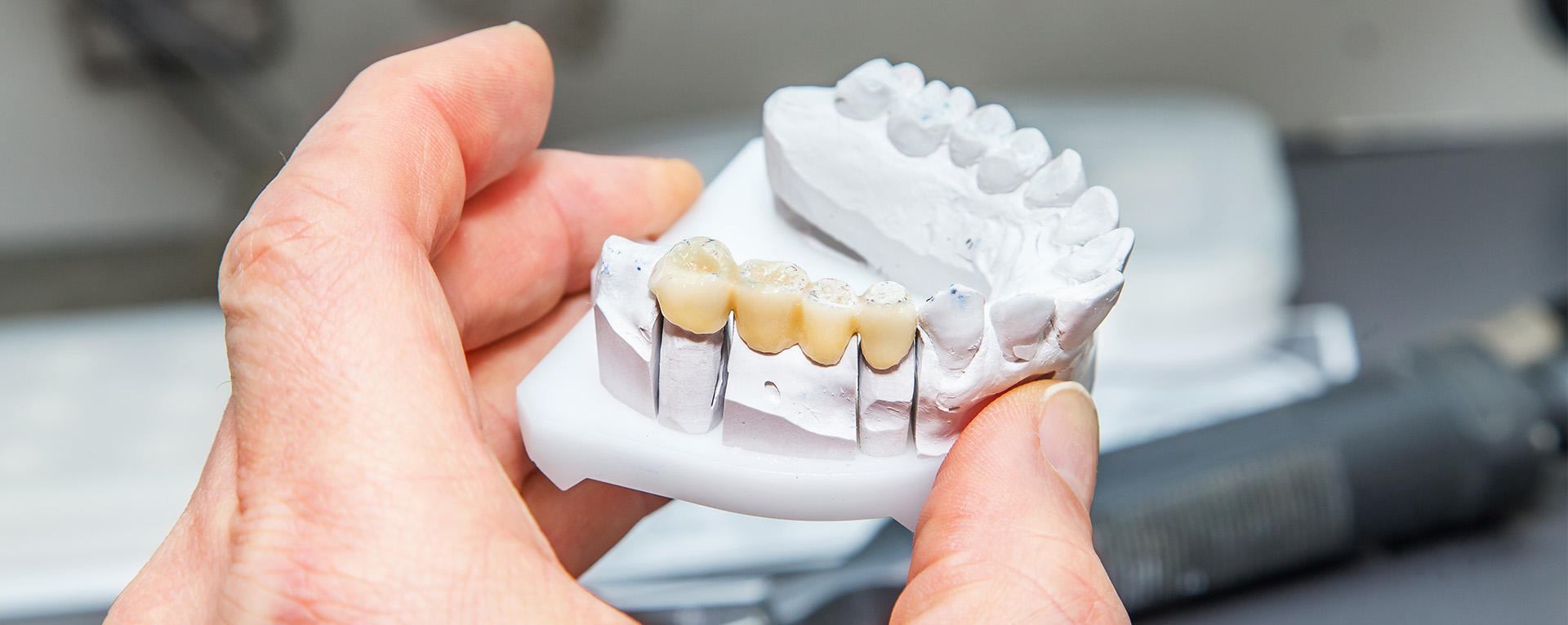 The image shows a person holding a dental implant with multiple teeth structures attached to it, possibly for a dental prosthetic or implantation procedure.