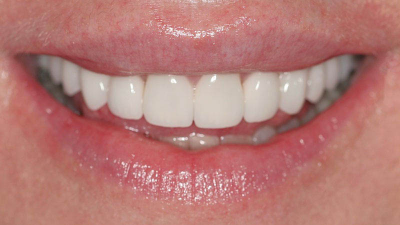 The image shows a close-up of a person's smiling face with white teeth and pink lips, set against a neutral background.