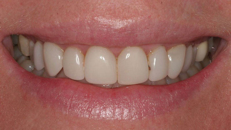 The image shows a close-up of a person's mouth with a bright smile, displaying white teeth and pink gums, against a blurred background.
