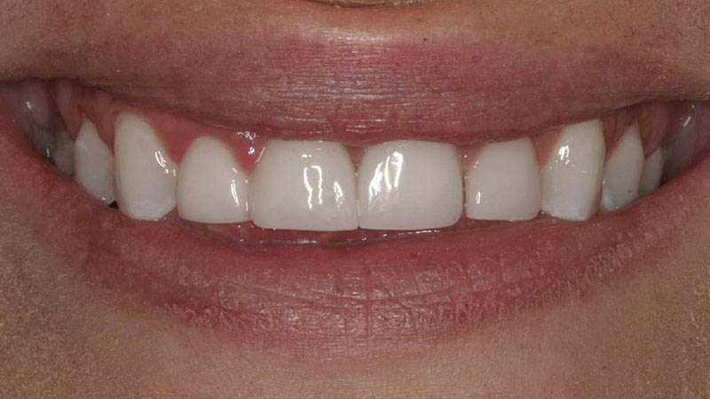 The image shows a person smiling with bright white teeth, capturing a close-up view of their mouth and teeth.