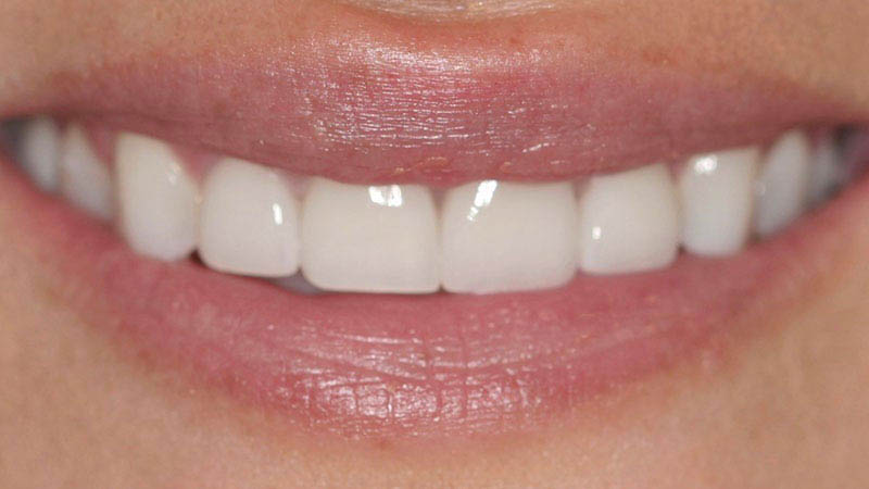 The image shows a close-up of a person's face with a bright smile, displaying straight teeth and glossy lipstick against a neutral background.