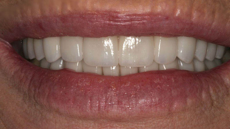 The image displays a close-up view of a person's lower face, focusing on their teeth and lips.