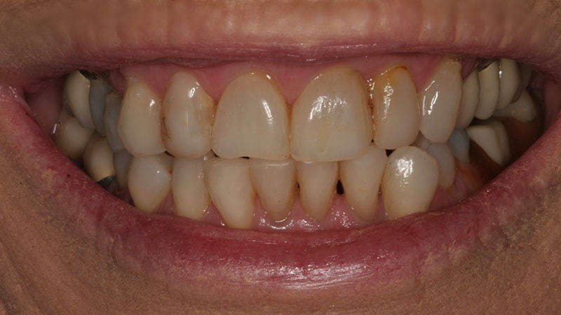 The image shows a close-up view of a person's teeth with a yellowish hue, likely due to staining or discoloration, against a blurred background that appears to be indoors with warm lighting.