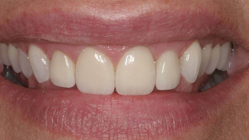 The image shows a close-up view of a person s smiling mouth with straight white teeth and a pink tongue, against a neutral background.