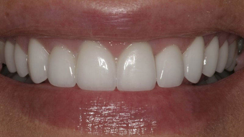The image shows a close-up of a person's smiling mouth with white teeth and pink gums, against a blurred background.