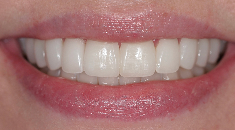 Metro Smiles | Restorative Dentistry, Botox® Injections and Xeomin® Injections