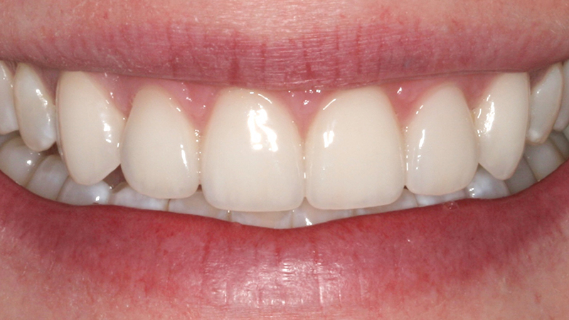 Metro Smiles | Dental Bridges, Dysport reg  Injections and Invisalign reg 