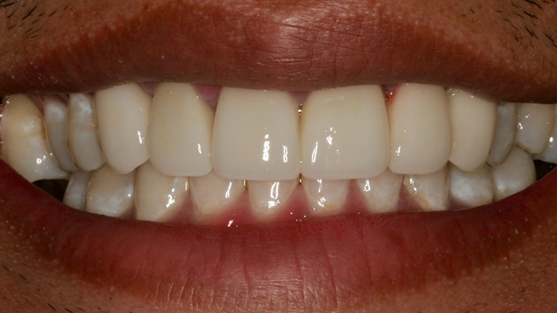 Metro Smiles | Preventive Care, No-Prep Veneers and Xeomin reg  Injections