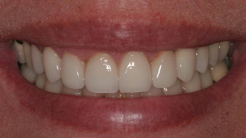 Metro Smiles | Dental Implants, Botox reg  Injections and Dental Bridges