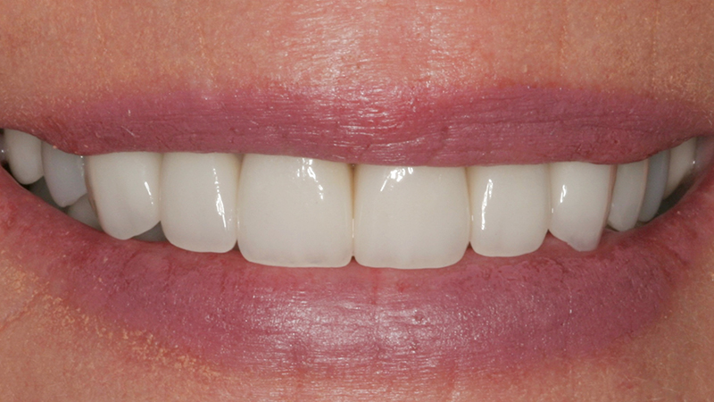 Metro Smiles | Xeomin reg  Injections, Dental Implants and Invisalign reg 