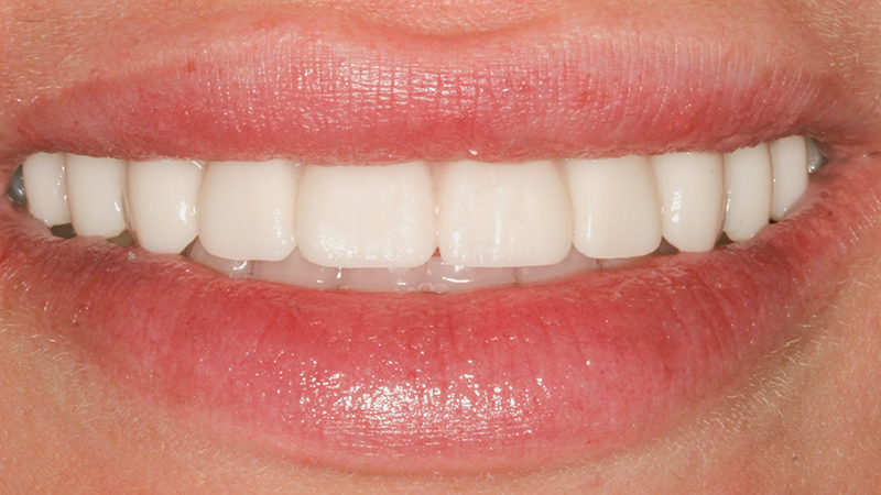 Metro Smiles | Composite Fillings, Other Services and Restorative Dentistry