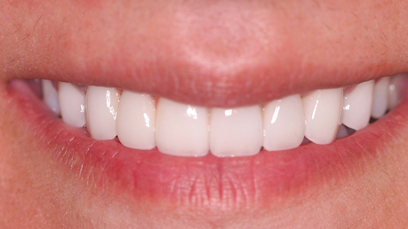 Metro Smiles | Porcelain Crowns, Porcelain Veneers and Restorative Dentistry
