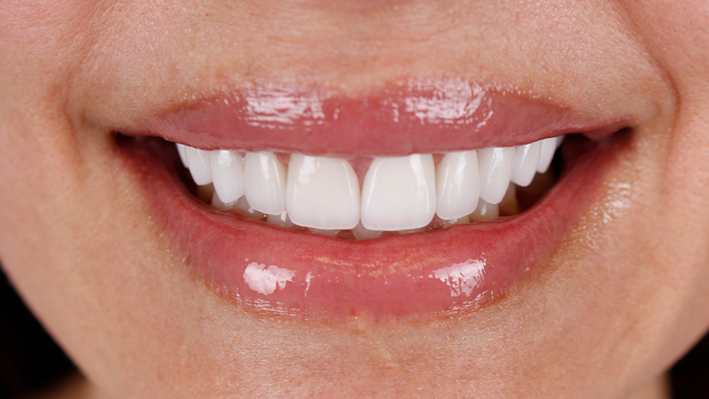 Metro Smiles | Xeomin reg  Injections, Dental Bridges and Dysport reg  Injections