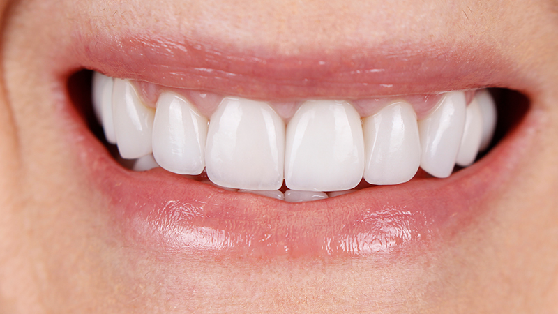 Metro Smiles | Dental Bridges, Laser Dentistry and Botox reg  Injections