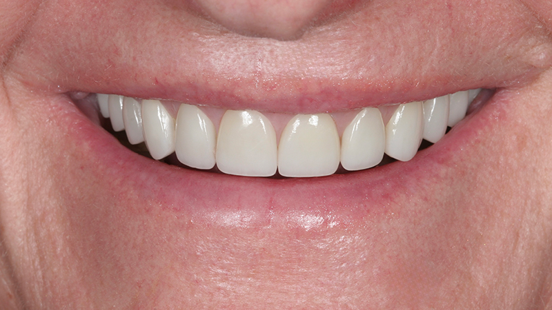 Metro Smiles | Restorative Dentistry, Laser Dentistry and Cosmetic Dentistry