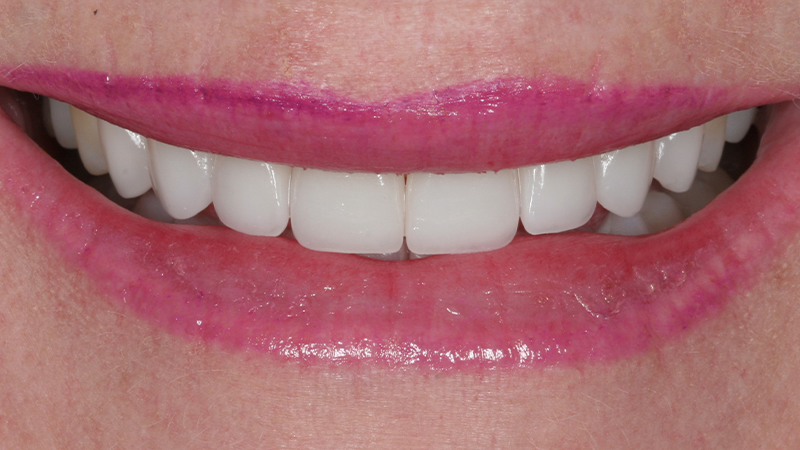 Metro Smiles | Porcelain Crowns, Other Services and Invisalign reg 