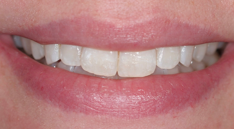 Metro Smiles | Other Services, Dental Implants and Laser Dentistry