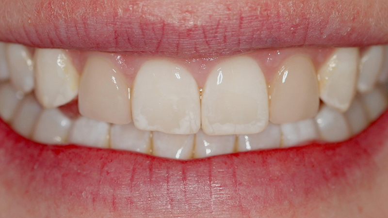 Metro Smiles | Preventive Care, Dental Implants and Restorative Dentistry