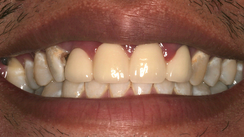 Metro Smiles | No-Prep Veneers, Dysport reg  Injections and Preventive Care