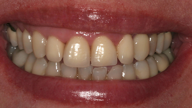 Metro Smiles | Dental Bridges, Cosmetic Dentistry and Porcelain Crowns