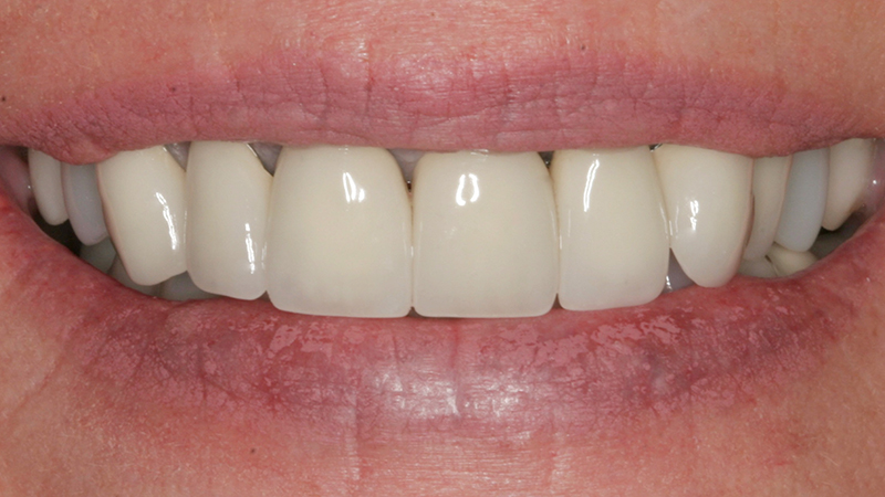 Metro Smiles | Porcelain Veneers, Laser Dentistry and Cosmetic Dentistry