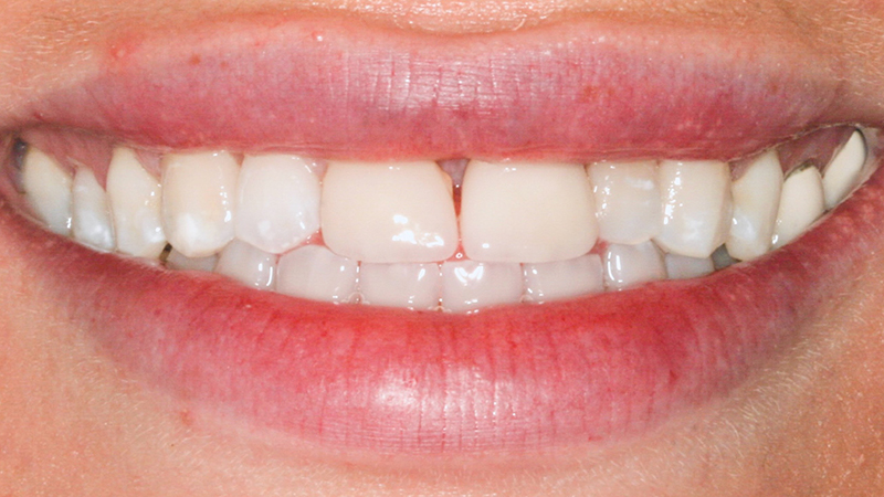 Metro Smiles | Other Services, Porcelain Veneers and Cosmetic Dentistry