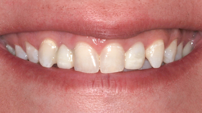 Metro Smiles | Preventive Care, Restorative Dentistry and Invisalign reg 
