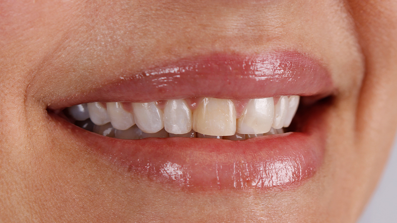 Metro Smiles | No-Prep Veneers, Preventive Care and Composite Fillings