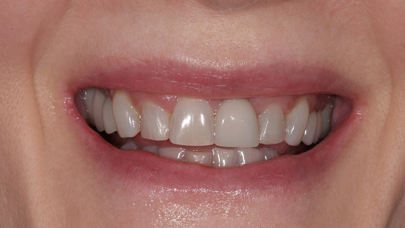 Metro Smiles | Dental Implants, Botox reg  Injections and Xeomin reg  Injections