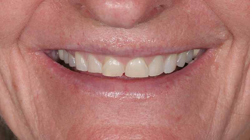 Metro Smiles | Xeomin reg  Injections, Teeth Whitening and Porcelain Veneers