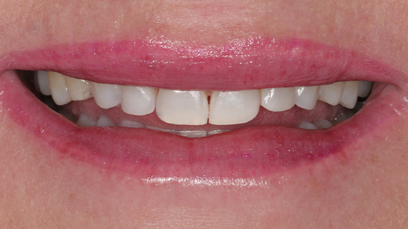 Metro Smiles | Porcelain Crowns, Botox reg  Injections and Invisalign reg 