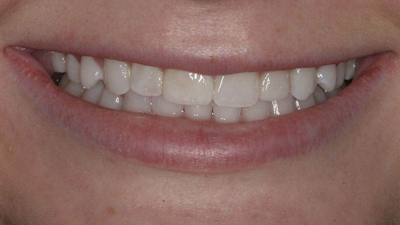 The image shows a close-up of a person's smiling face with a focus on their teeth and lips.