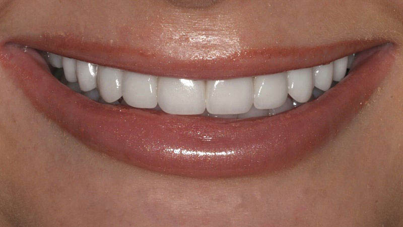 The image shows a close-up of a smiling person with white teeth and a glossy lipstick finish, against a blurred background.