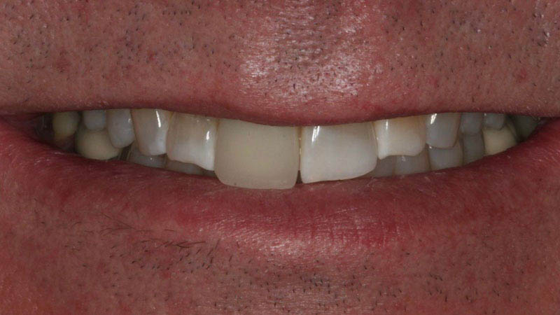 The image shows a close-up of a person s face with a focus on their teeth, which are in good condition, and they appear to be smiling slightly.