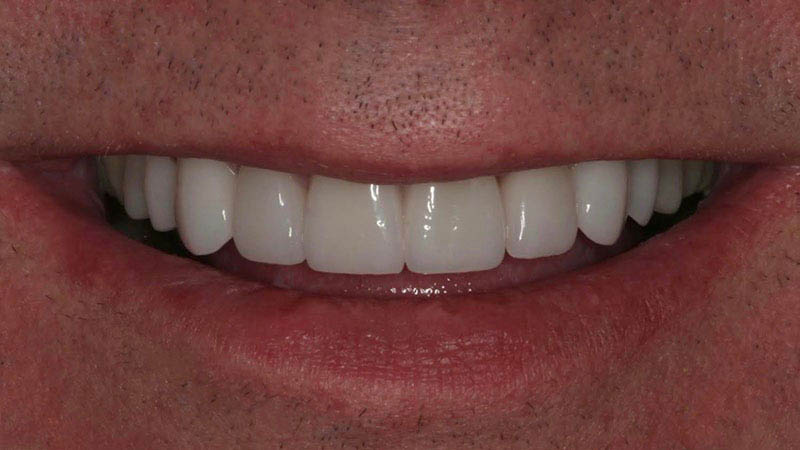 The image shows a close-up of a person s smiling face with a focus on their teeth and lips, set against a blurred background that appears to be a human figure.