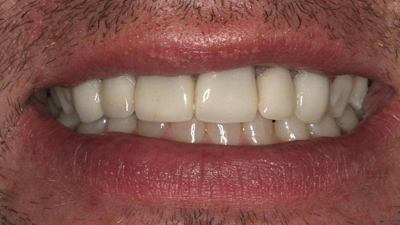 The image shows a close-up of a person s mouth displaying white teeth and gums, with visible stubble on the chin.