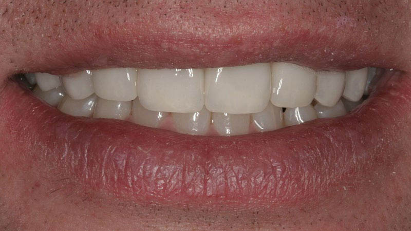 The image shows a close-up view of a person s mouth with a large smile revealing white teeth and gums, against a blurred background.