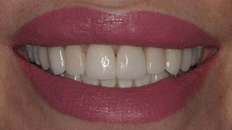 The image shows a close-up of a person's face with pink lipstick, displaying a bright smile revealing white teeth.