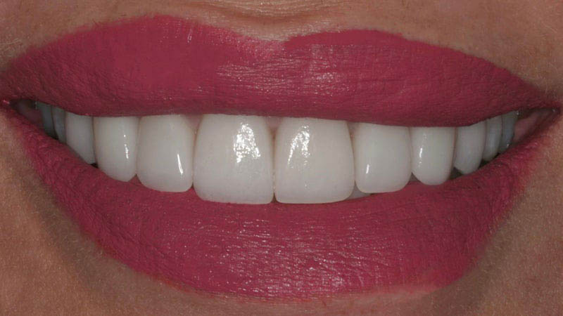 The image shows a close-up of a person with red lipstick wearing a white smile.