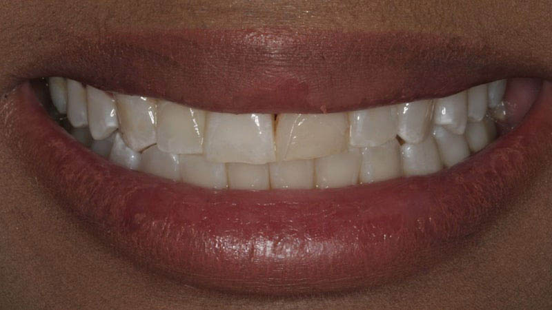 The image shows a close-up view of a person's smiling mouth with white teeth and visible gumline, against a blurred background.