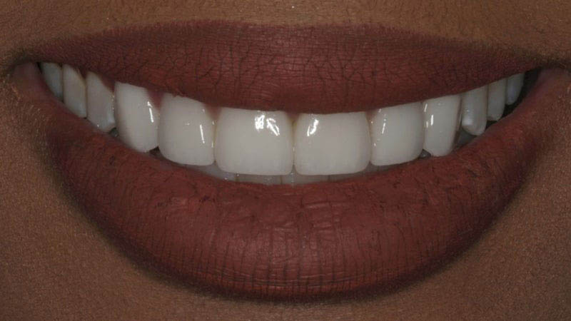 The image features a close-up of a person's smiling face with red lipstick, showcasing their teeth and lips, against a neutral background.